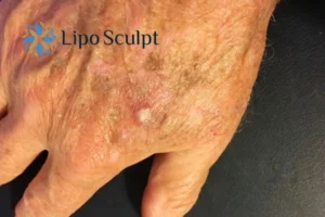 Best Actinic Keratoses Removal 2 Improve your wellbeing and health with Actinic Keratoses Taunton removal.treatment