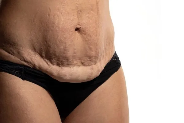 Lost the Weight but Not the Loose Skin? 1 image of womans stomach after weight loss showing loose skin Taunton